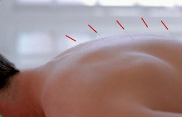 doctor_sonriendo_acupuntura